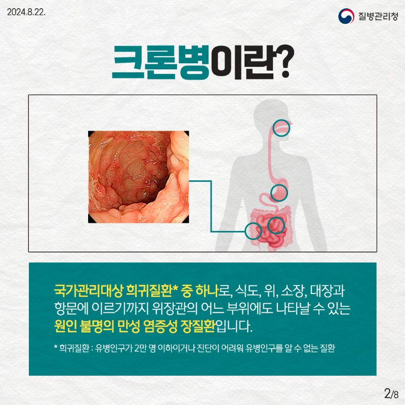 240821_희귀질환_크론병2.jpg