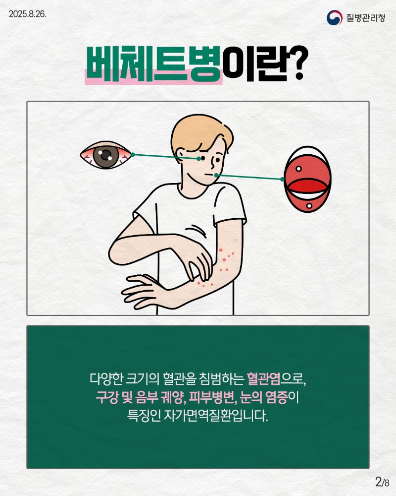 250825-희귀질환-베체트병2.jpg